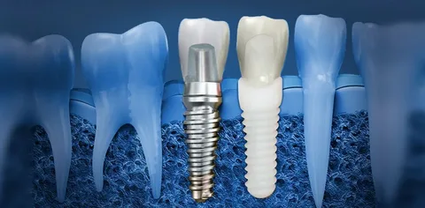 Why Consider Dental Implants Abroad